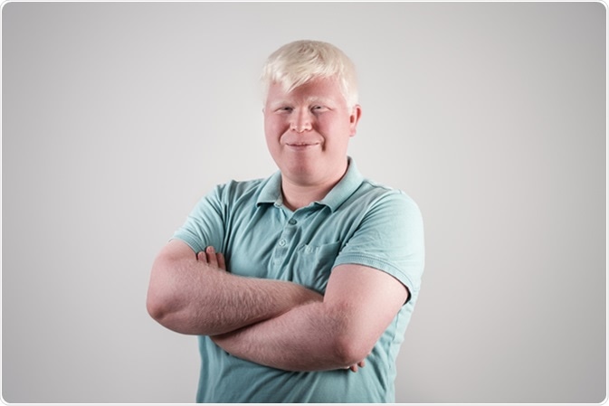 Albino young man portrait. Image Credit: Sondem / Shuttertock